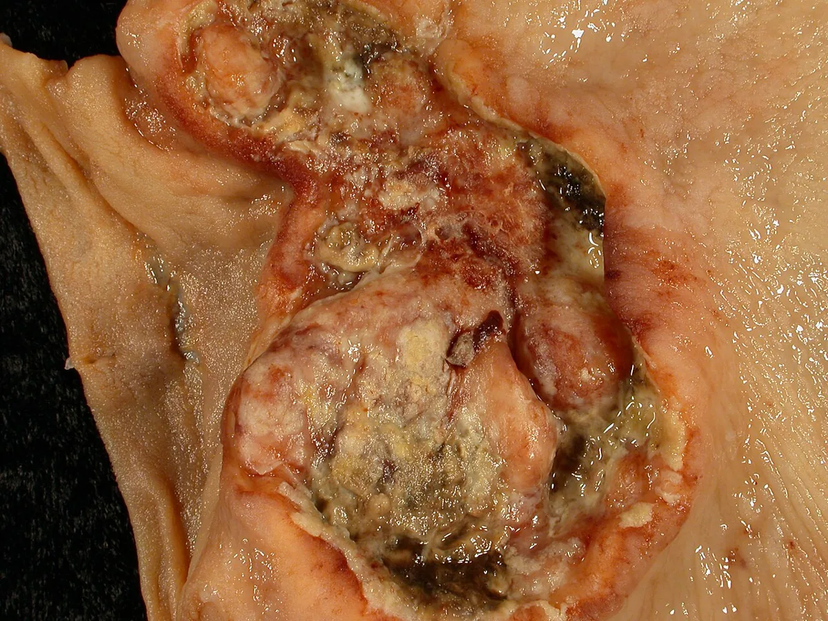 Gastric cancer – gross specimen: Opened stomach: ulcerated carcinoma with raised margins and necrotic base