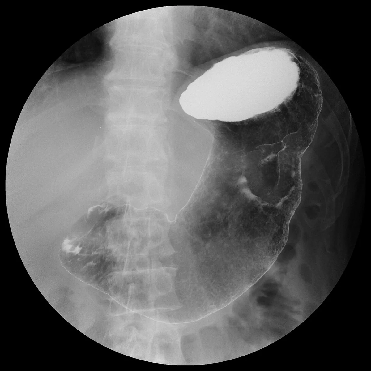 Gastric cancer – X-ray: Double-contrast barium study: tumor in the upper stomach (Borrmann type 2)