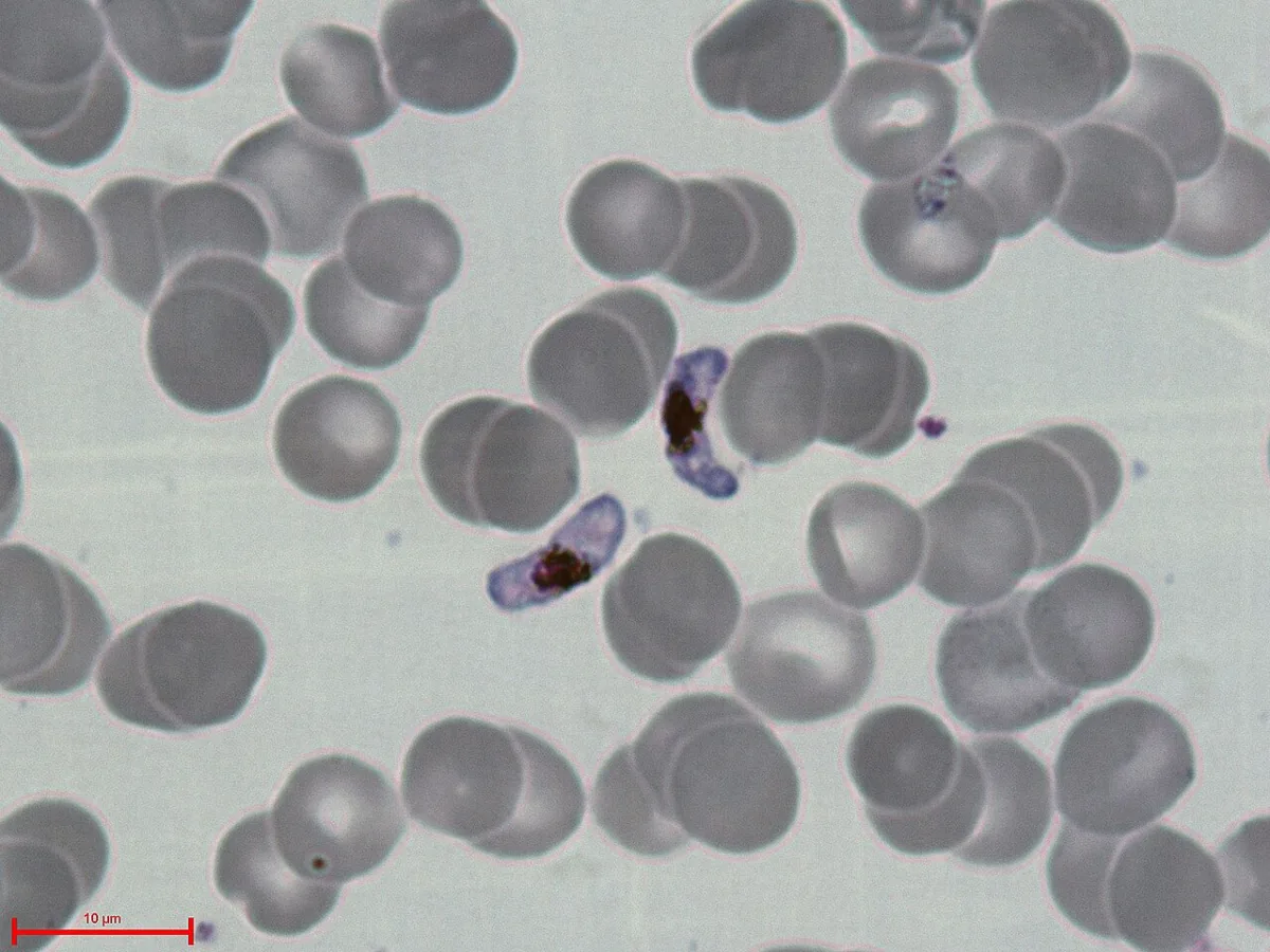 Malaria – blood smear/cytology: Blood film: two crescent- or banana-shaped gametocytes of Plasmodium falciparum with dark pigment