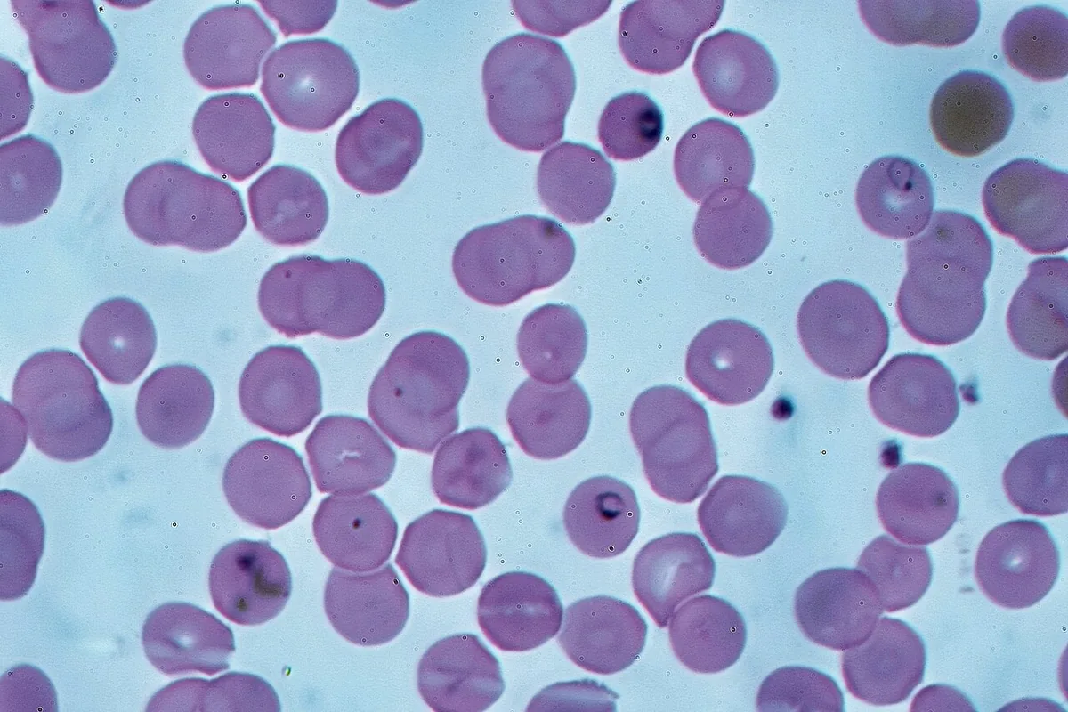 Malaria – blood smear/cytology: Thin blood film (Giemsa): delicate ring forms of Plasmodium falciparum in several red cells