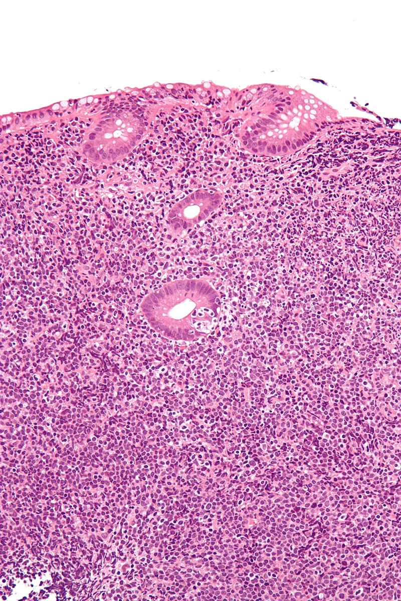 MALT lymphoma – histology: Gastric mucosa in MALT lymphoma: dense infiltrate of small lymphocytes invading glands (lymphoepithelial lesion)