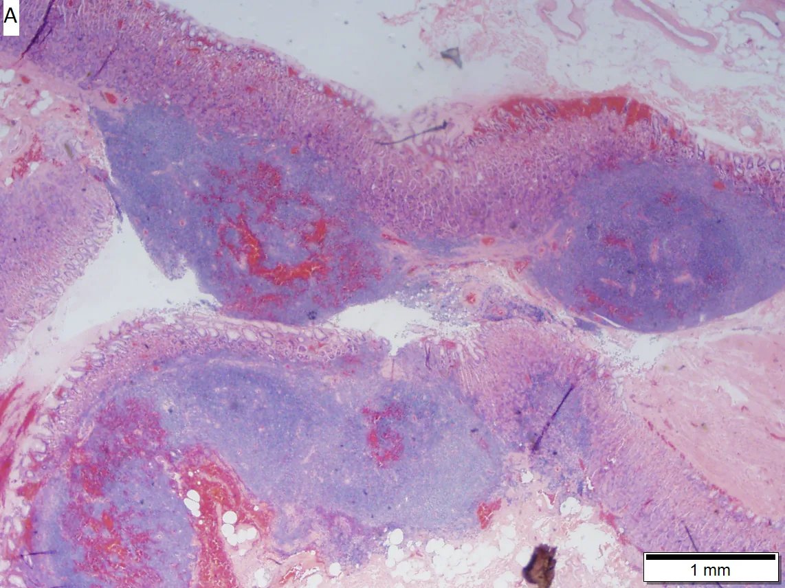 MALT lymphoma – Low-power histology of gastric MALT lymphoma: nodular lymphoid infiltrates in the stomach wall