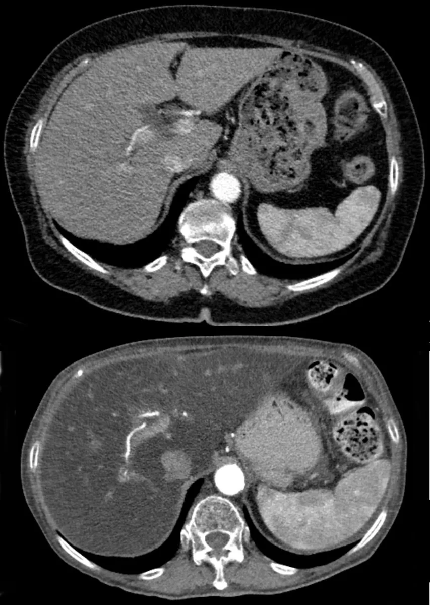 Steatotic liver disease (fatty liver, MASLD) – CT comparison: top, normal liver; bottom, the same patient with marked hepatic steatosis – liver clearly hypodense relative to spleen and vessels