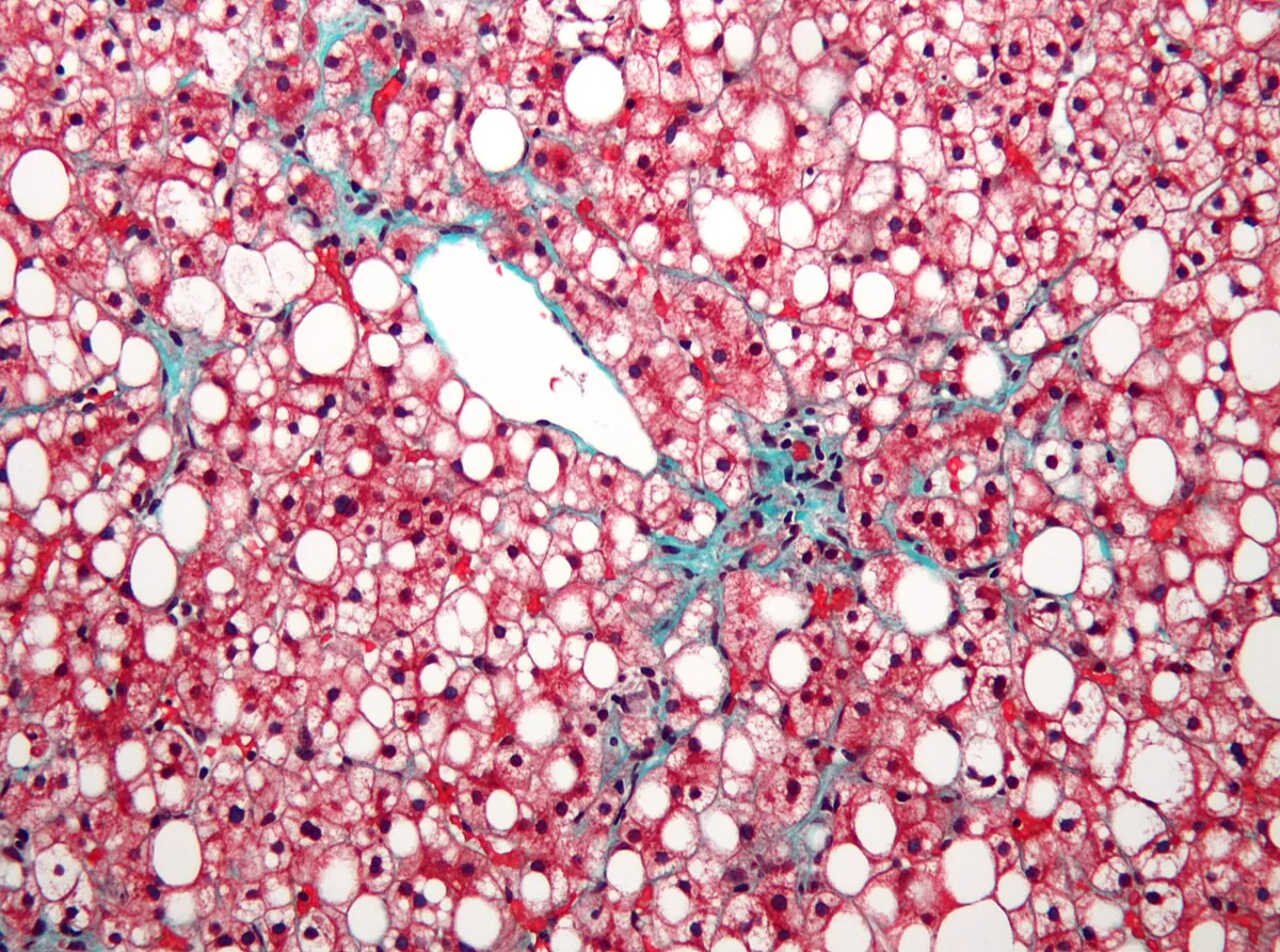 Steatotic liver disease (fatty liver, MASLD) – Histology (Masson trichrome) in non-alcoholic fatty liver disease: marked macrovesicular steatosis of hepatocytes around the central vein, mild fibrosis