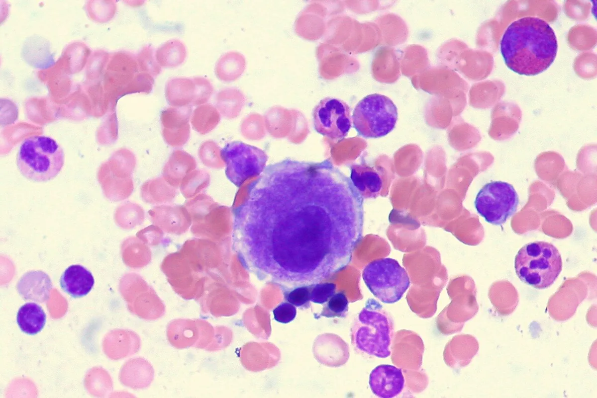 Myelodysplastic syndromes (MDS) – Bone marrow smear in MDS: small dysplastic megakaryocyte with an abnormally hypolobated nucleus