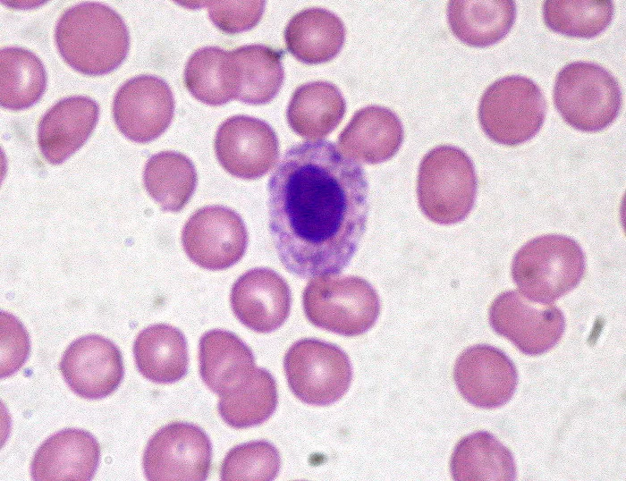 Myelodysplastic syndromes (MDS) – Blood smear: hypogranular neutrophil with a non-lobed, round nucleus (pseudo-Pelger cell) as a sign of dysplasia
