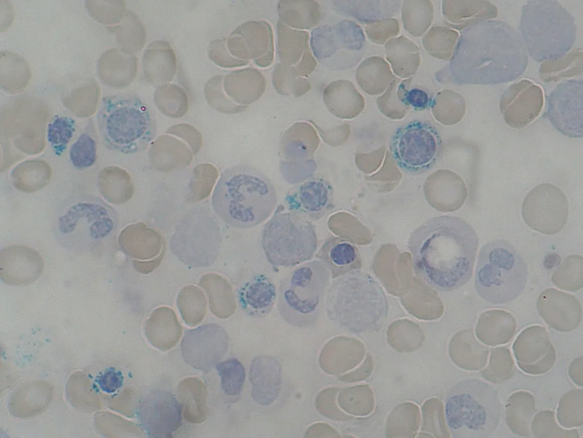 Myelodysplastic syndromes (MDS) – blood smear/cytology: Iron stain (Prussian blue) of bone marrow: ring sideroblasts with blue iron granules encircling the nucleus