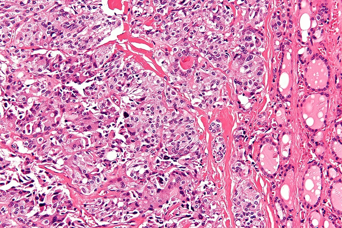 Multiple endocrine neoplasia (MEN 1 and MEN 2) – Medullary thyroid carcinoma (H&E): nests of round to spindle tumor cells with eosinophilic amyloid in the stroma
