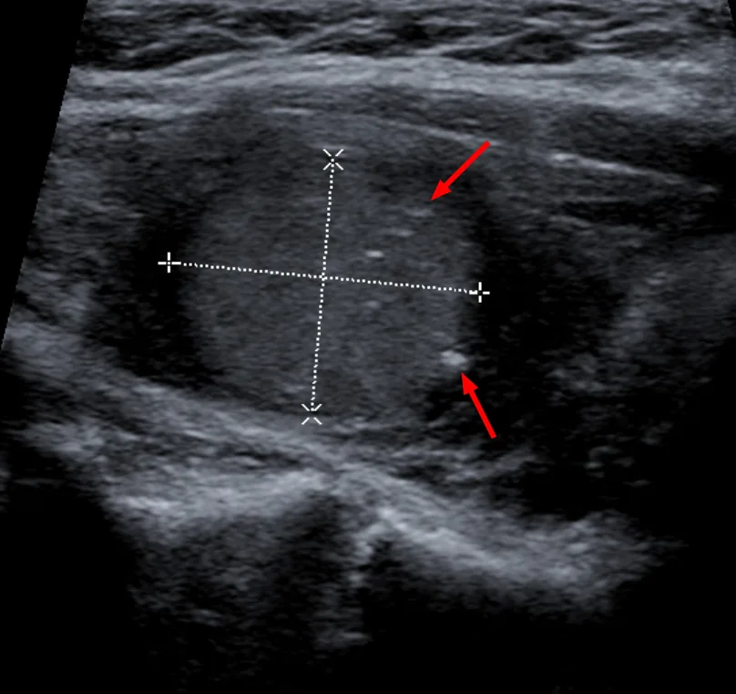 Multiple endocrine neoplasia (MEN 1 and MEN 2) – Ultrasound of a medullary thyroid carcinoma: hypoechoic nodule with echogenic calcifications (arrows)