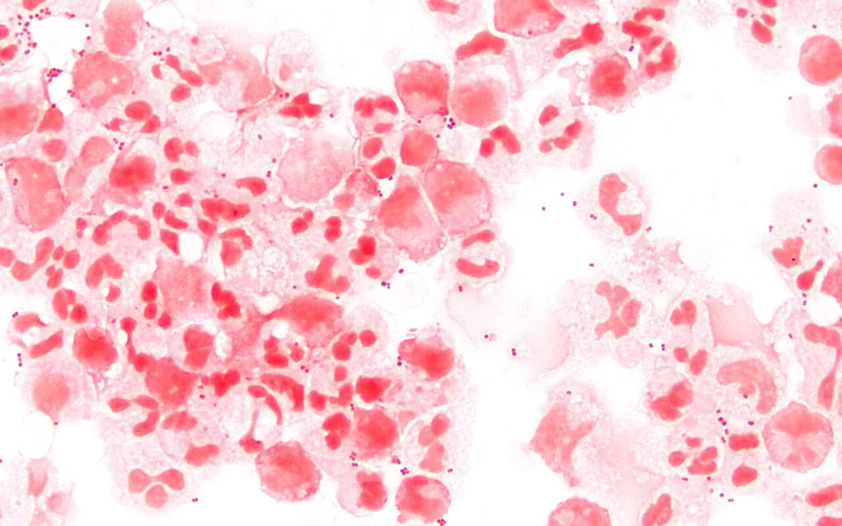 Bacterial meningitis – blood smear/cytology: Gram stain of CSF: Gram-negative diplococci (Neisseria meningitidis) among neutrophils