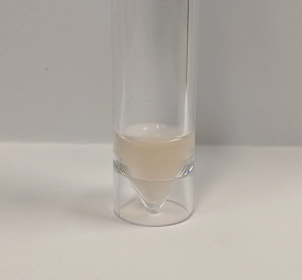 Bacterial meningitis – clinical photo: Cloudy, milky cerebrospinal fluid in bacterial (streptococcal) meningitis