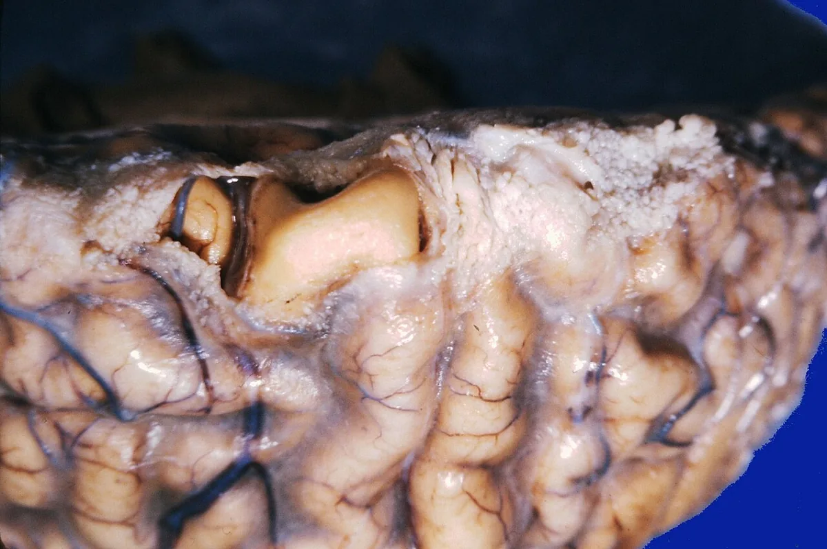 Bacterial meningitis – gross specimen: Autopsy specimen in pneumococcal meningitis: yellowish-white purulent exudate in the leptomeninges over the cerebral gyri