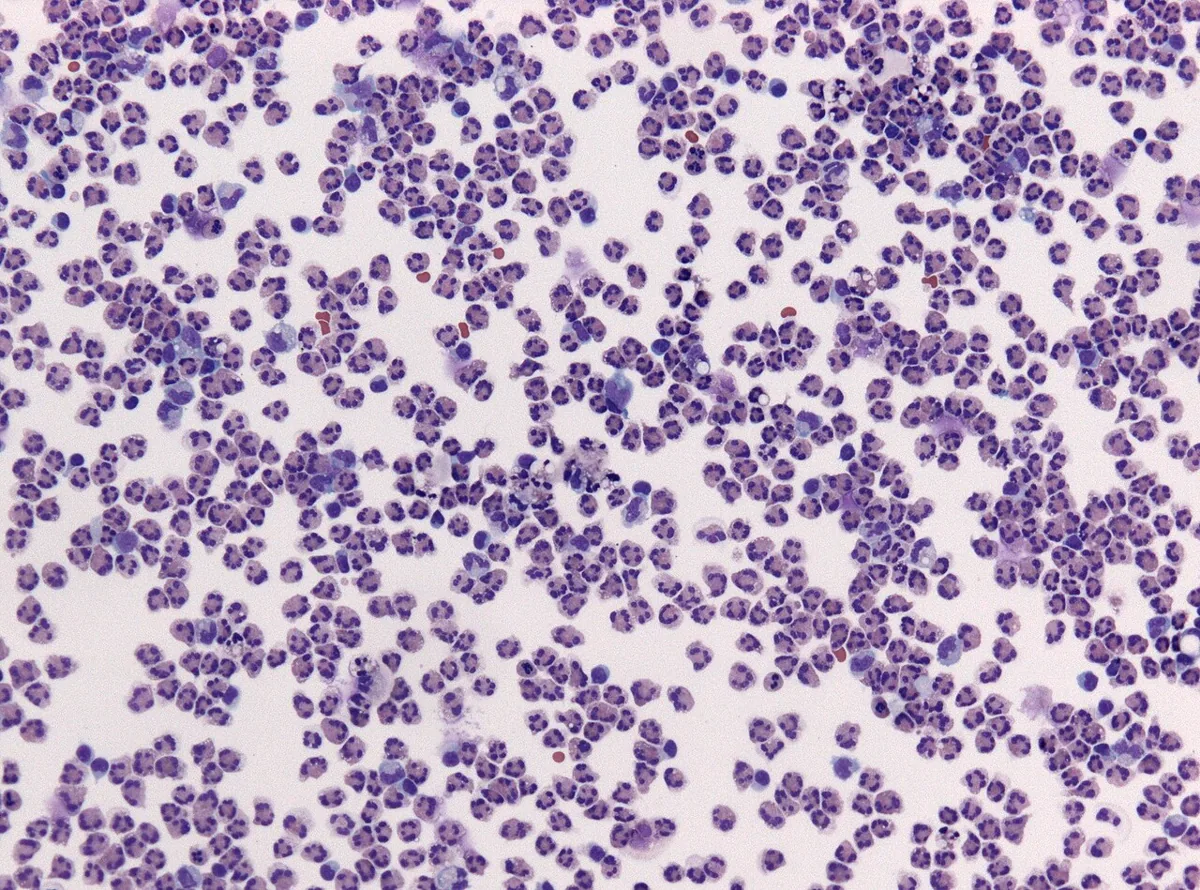 Bacterial meningitis – CSF cytology (Pappenheim stain): masses of neutrophils – neutrophilic pleocytosis in purulent meningitis