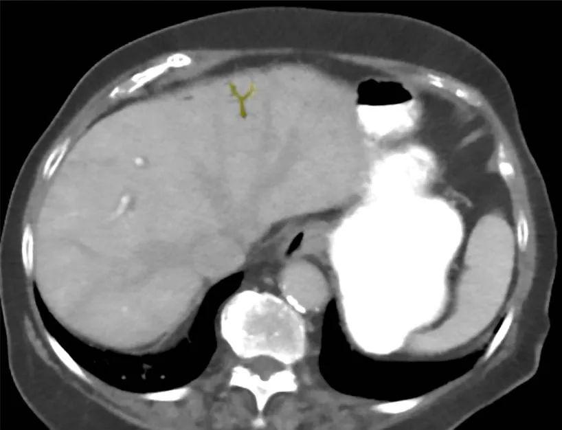 Acute mesenteric ischemia – CT in advanced mesenteric ischemia: branching gas collections in the portal vein branches of the liver (highlighted)