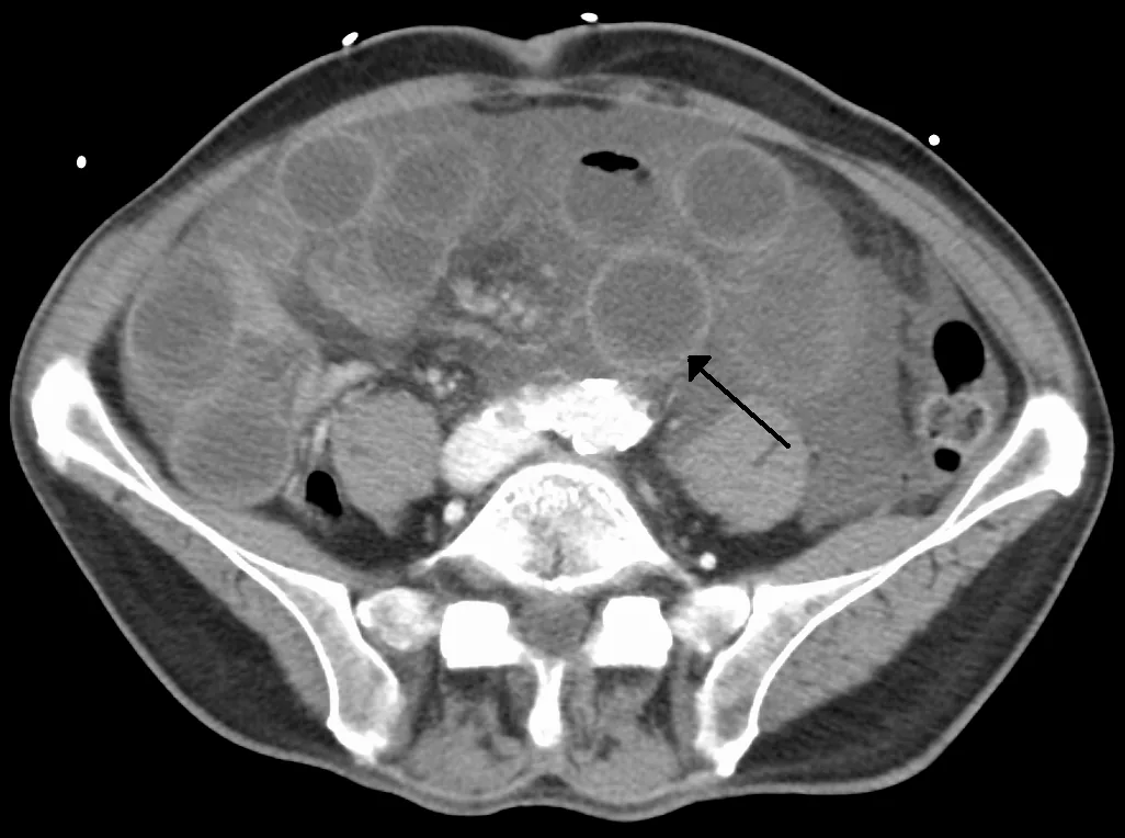 Acute mesenteric ischemia – CT in mesenteric vein thrombosis: fluid-filled, dilated small-bowel loops with thickened, layered walls (arrow) and free fluid