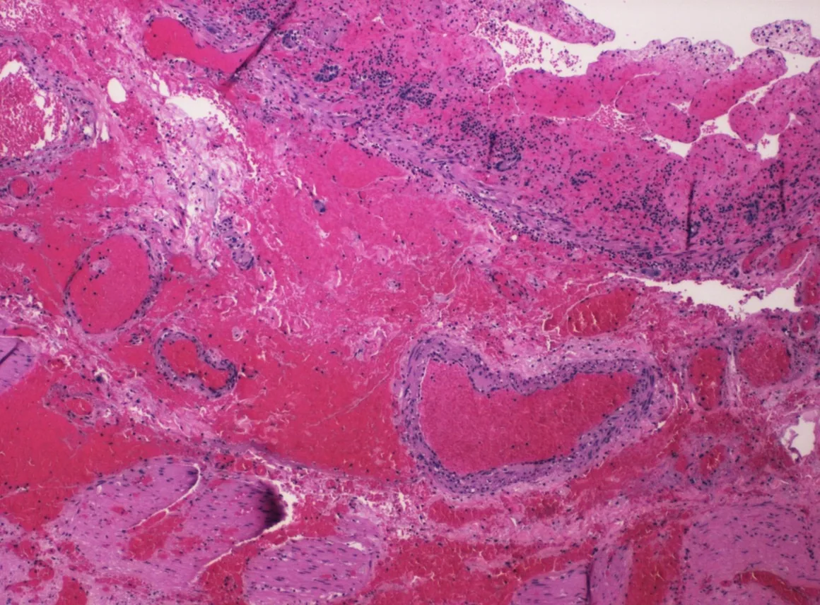 Acute mesenteric ischemia – Histology (H&E) of bowel gangrene: transmural hemorrhage, congested vessels and wall necrosis (here from volvulus) – the picture of hemorrhagic bowel infarction
