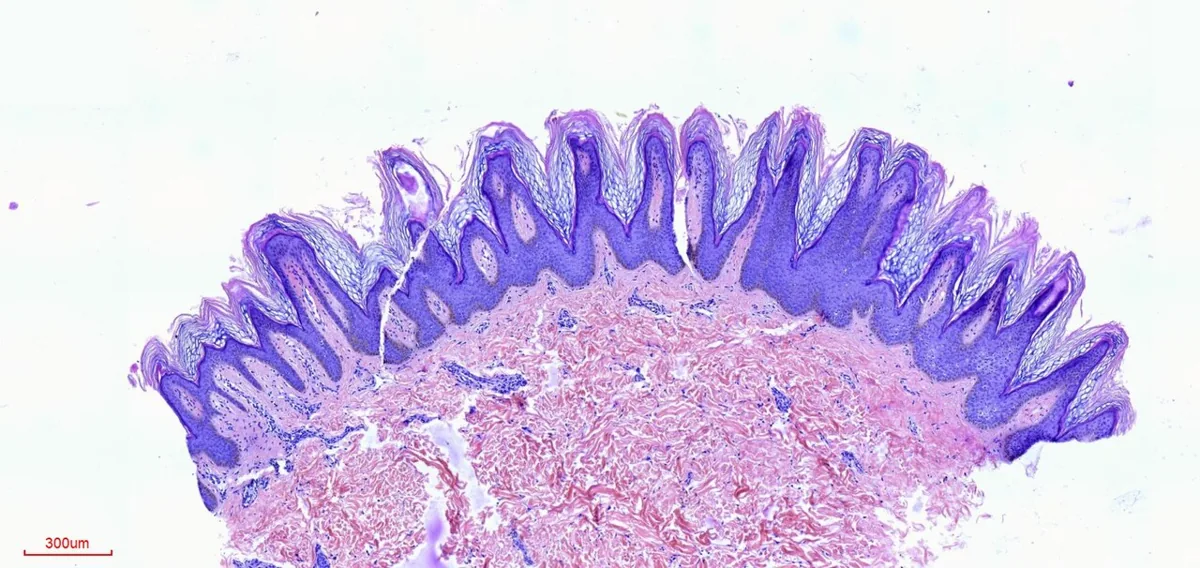 Metabolic syndrome – Histology of acanthosis nigricans (H&E): regular papillomatosis and hyperkeratosis without inflammation