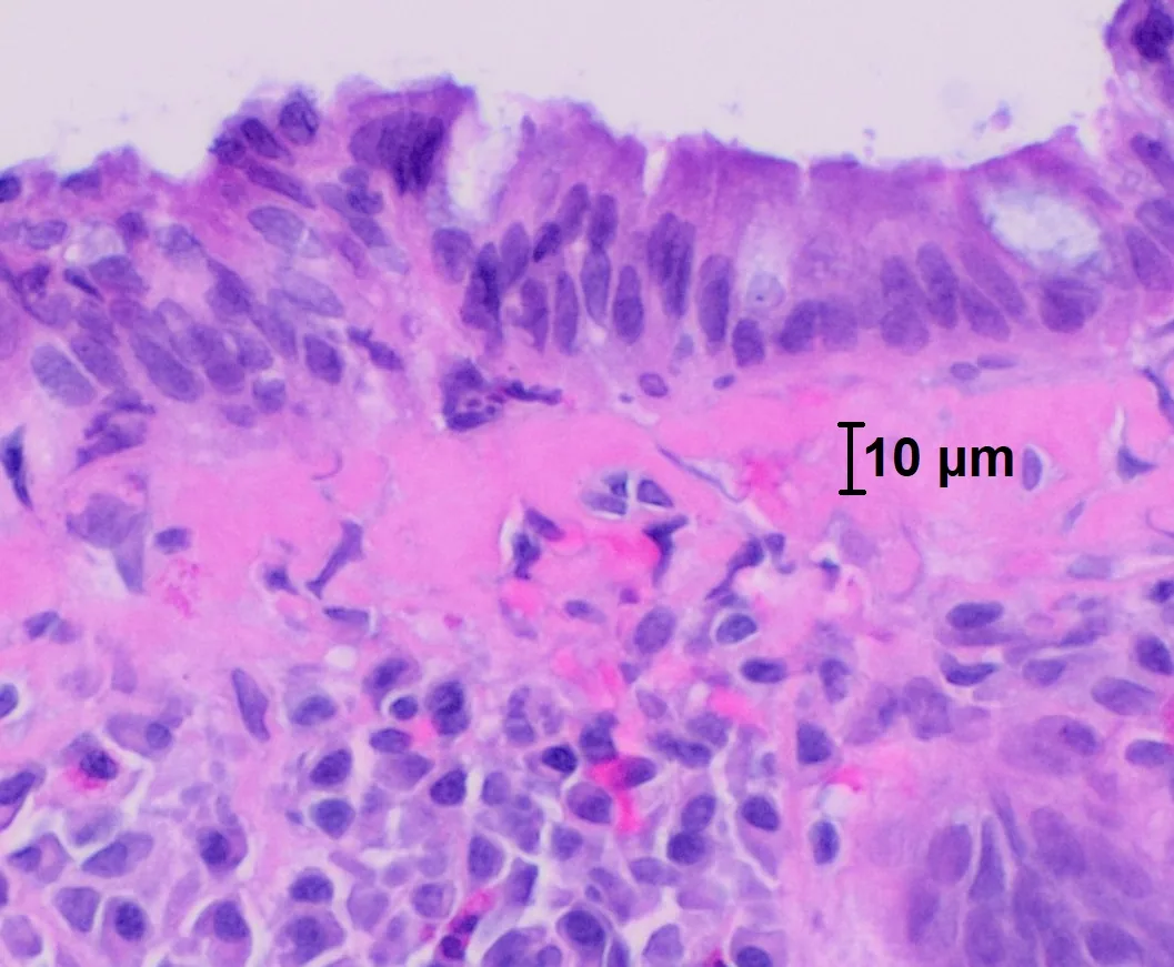 Microscopic colitis – Histology (H&E): thickened subepithelial collagen band (over 10 µm) in collagenous colitis