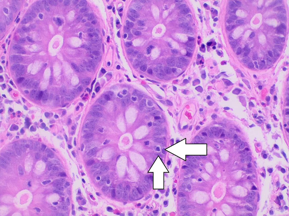 Microscopic colitis – Histology (H&E): increased intraepithelial lymphocytes in the crypts (arrows) in lymphocytic colitis