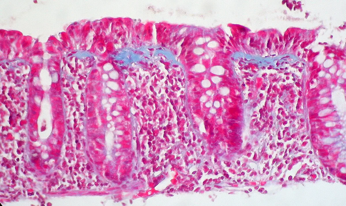 Microscopic colitis – histology: Trichrome stain: blue-stained, widened subepithelial collagen band in collagenous colitis