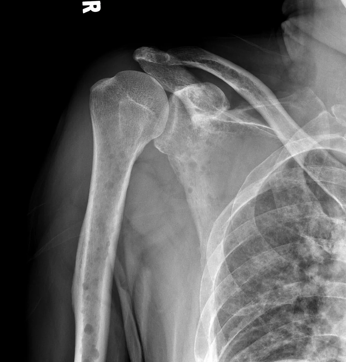 Multiple myeloma – Shoulder X-ray: numerous hole-like lytic lesions in humerus, scapula and ribs
