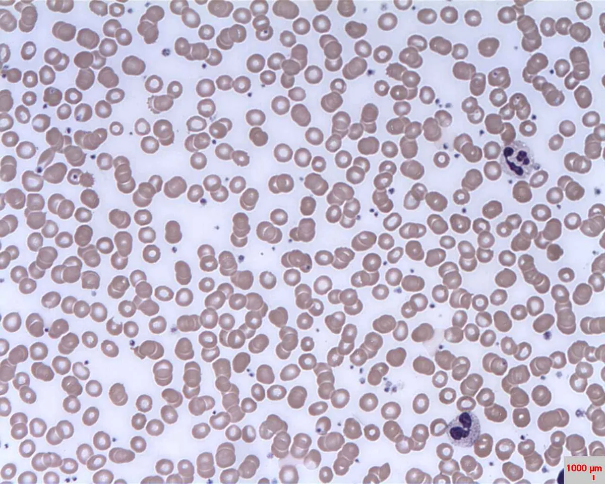 Multiple myeloma – Blood smear in multiple myeloma: red cells lying in many short, coin-stack chains (rouleaux formation)