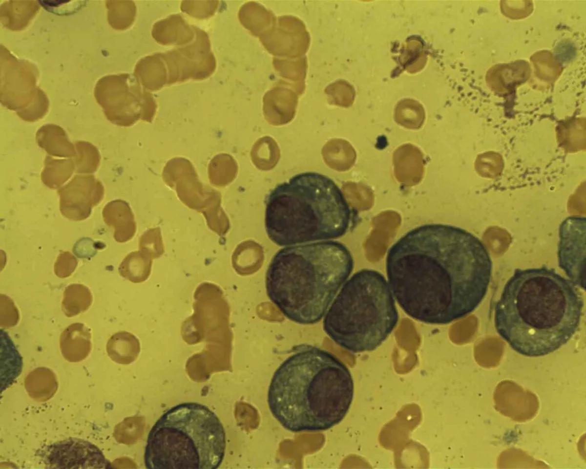 Multiple myeloma – Bone marrow smear in multiple myeloma: clusters of atypical plasma cells with eccentric nuclei and perinuclear clearing