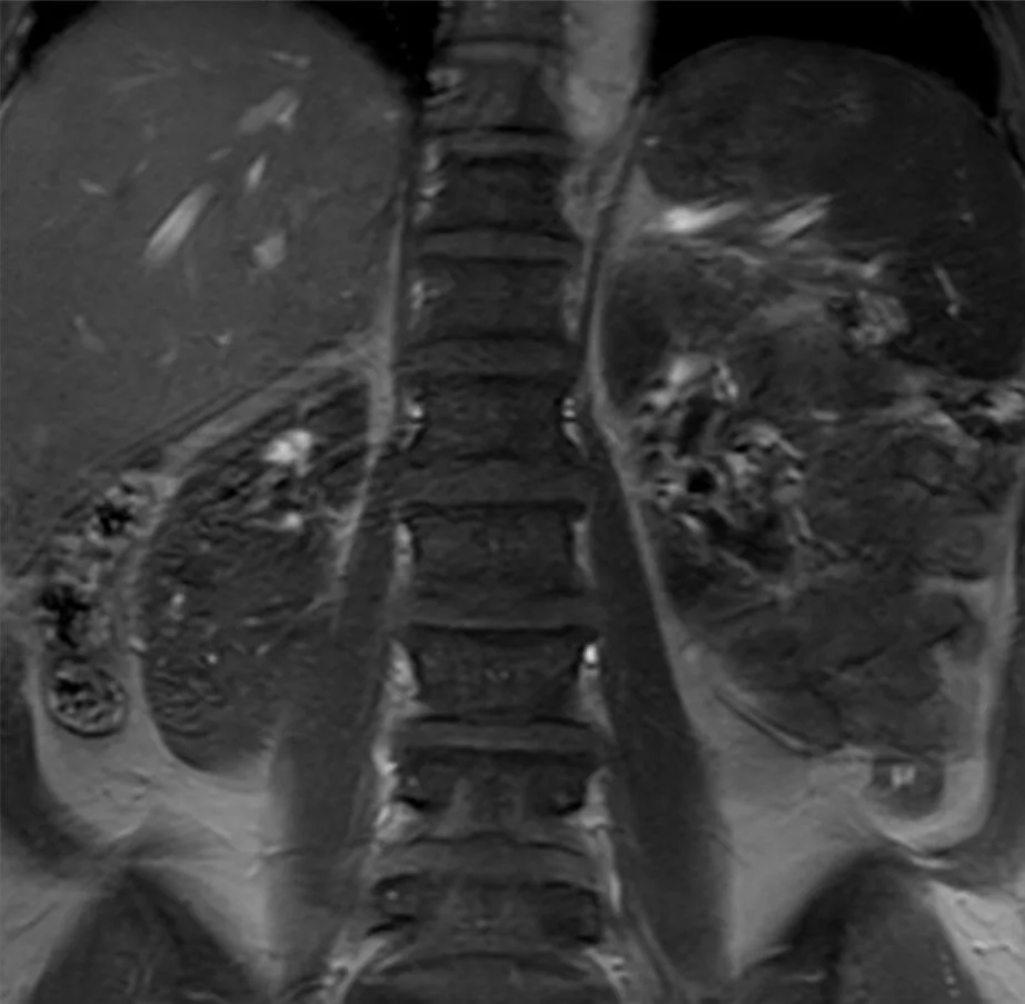 Multiple myeloma – MRI (T1, coronal): diffusely low-signal vertebral bone marrow due to myeloma infiltration