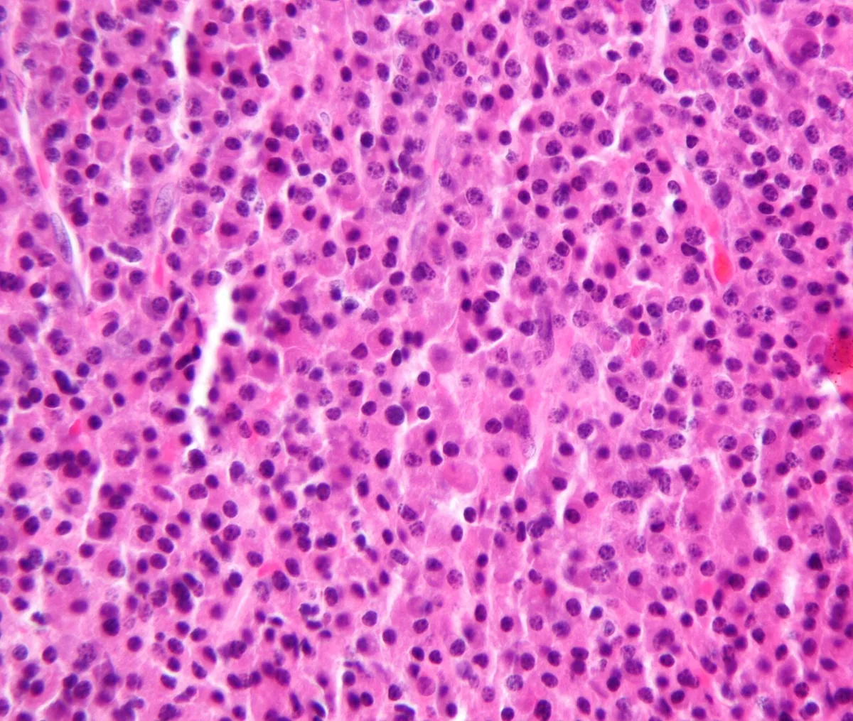 Multiple myeloma – Histology of a plasmacytoma (H&E): dense sheets of atypical plasma cells with eccentric nuclei