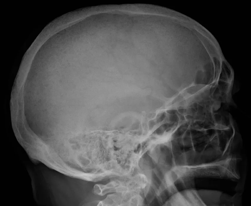 Multiple myeloma – Lateral skull X-ray: numerous small, sharply defined lucencies (lytic lesions, 'pepper-pot skull')
