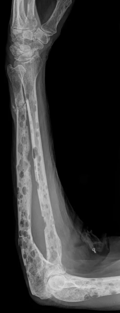 Multiple myeloma – Forearm X-ray: multiple punched-out lytic lesions in ulna and radius