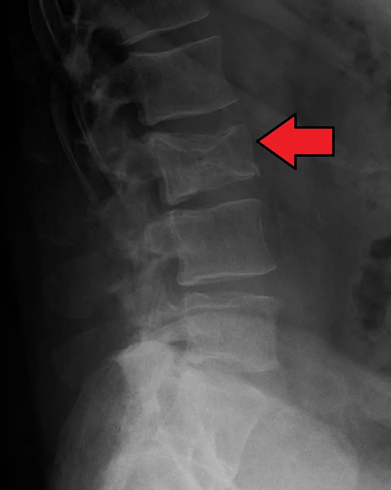 Multiple myeloma – Lateral lumbar spine X-ray: pathological compression fracture of a lumbar vertebra (arrow) in multiple myeloma