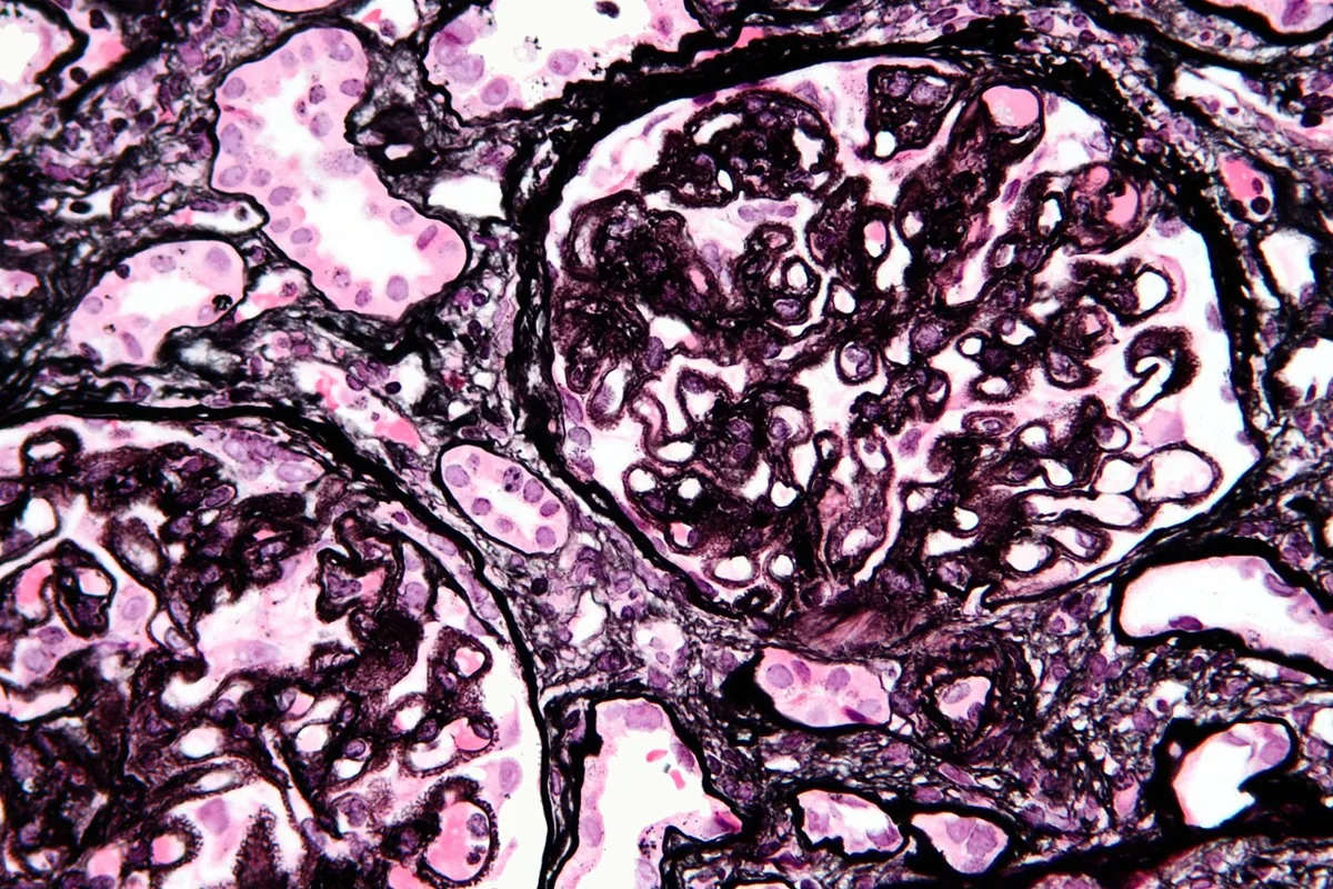 Membranous nephropathy – Histology (silver stain) in membranous nephropathy: thickened glomerular basement membranes with fine spikes
