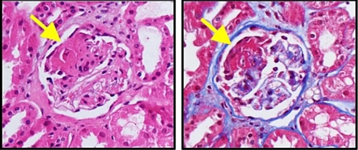 Microscopic polyangiitis – histology: Renal biopsy in ANCA-associated glomerulonephritis: fibrinoid necrosis in a glomerulus, eosinophilic on H&E (left) and red on trichrome (right, arrows)