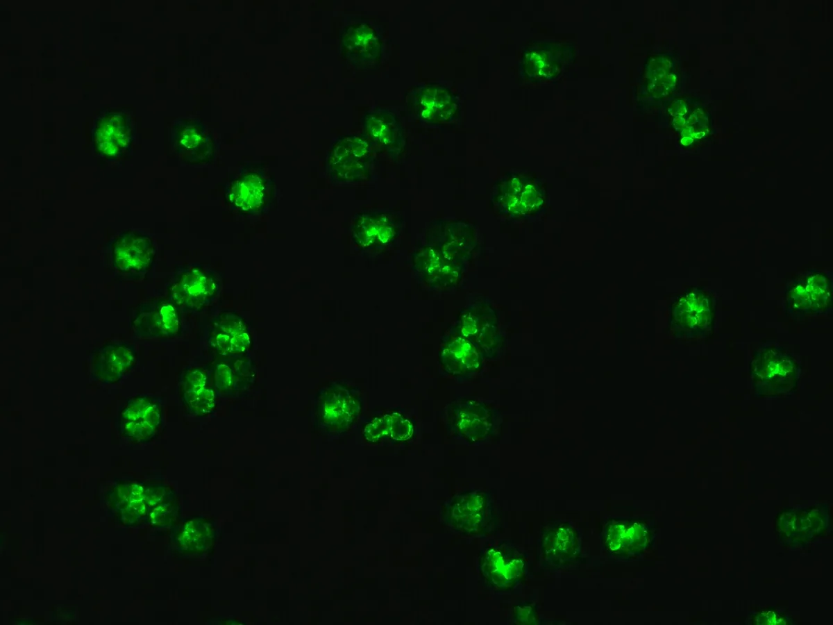 Microscopic polyangiitis – Indirect immunofluorescence on ethanol-fixed neutrophils: perinuclear pattern (p-ANCA) caused by MPO antibodies