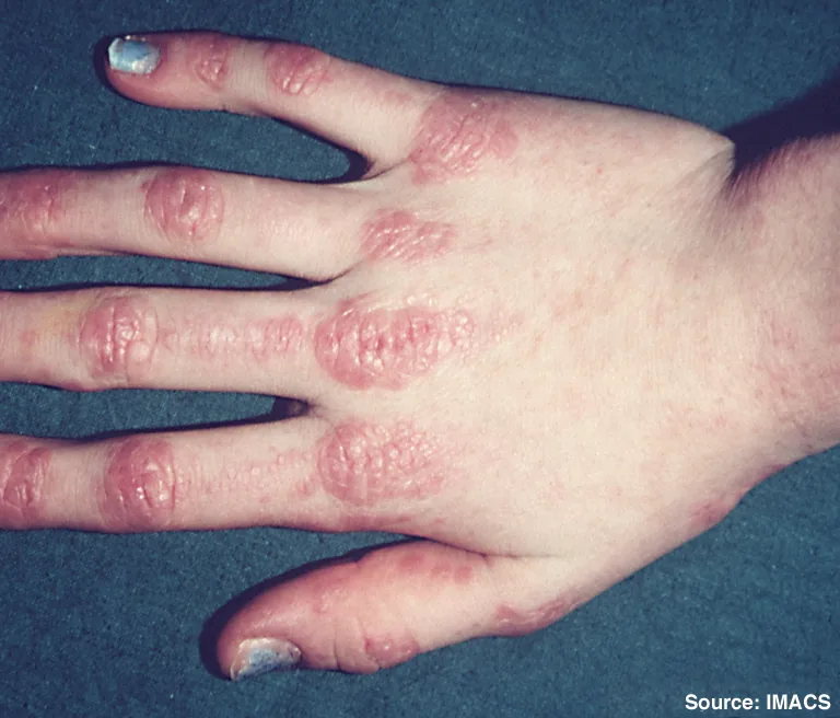 Dermatomyositis und Polymyositis – klinisches Foto: Gottron-Papeln: rötlich-livide, leicht schuppende Papeln über den Fingergelenken des Handrückens