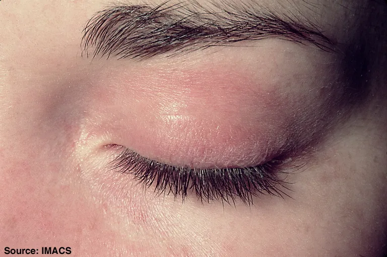 Dermatomyositis und Polymyositis – klinisches Foto: Heliotropes Erythem: violett-rötliche Verfärbung und Schwellung des Oberlids