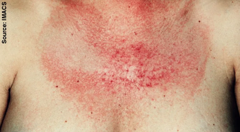 Dermatomyositis und Polymyositis – klinisches Foto: V-Zeichen: flächiges, fleckiges Erythem am oberen Brustausschnitt (lichtexponierte Haut)