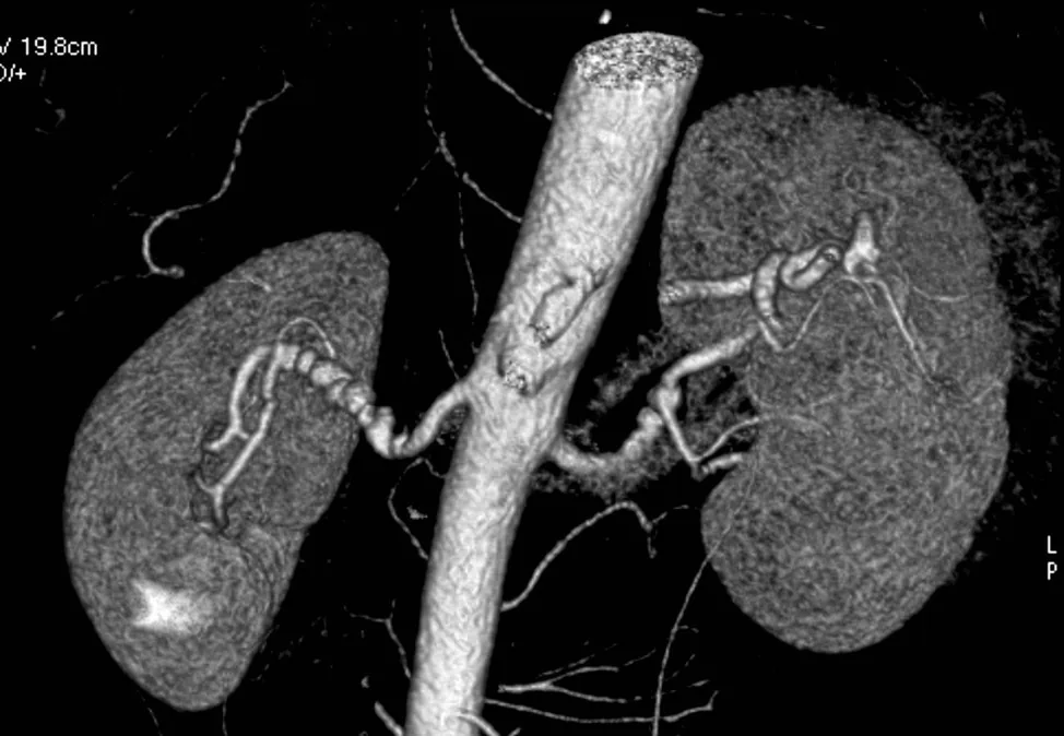 Renal artery stenosis – CT angiography (volume rendering) of the renal arteries: irregular, beaded calibre changes in fibromuscular dysplasia