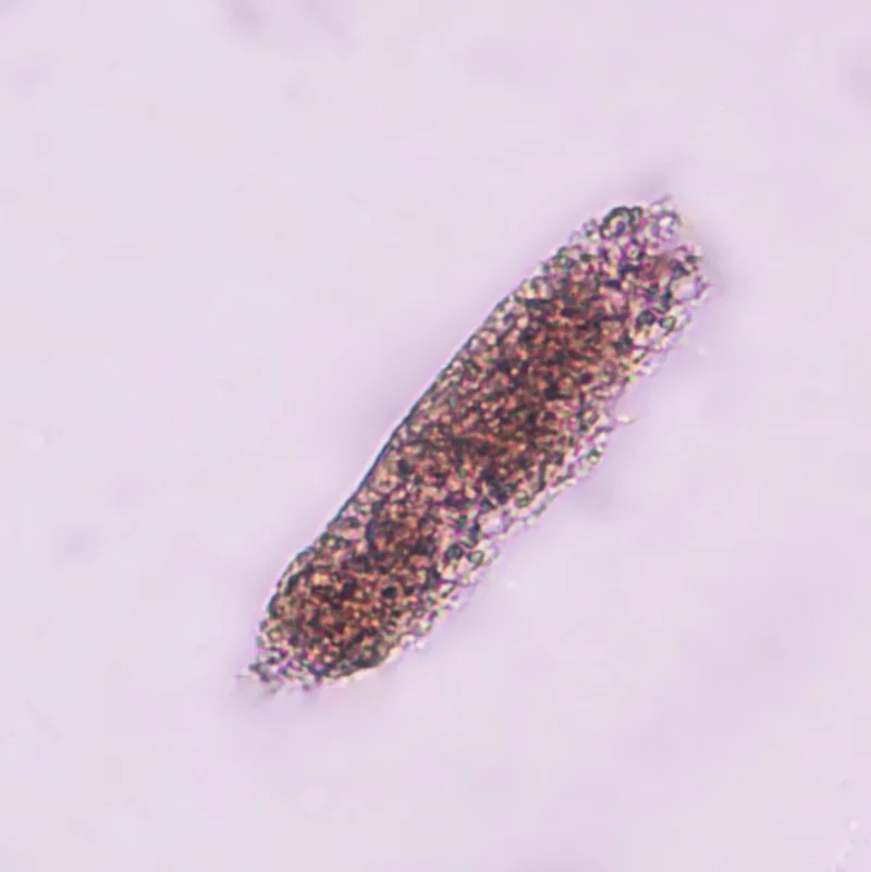 Nephritic syndrome and glomerulonephritis – blood smear/cytology: Urine sediment: red blood cell cast – a sign of glomerular bleeding