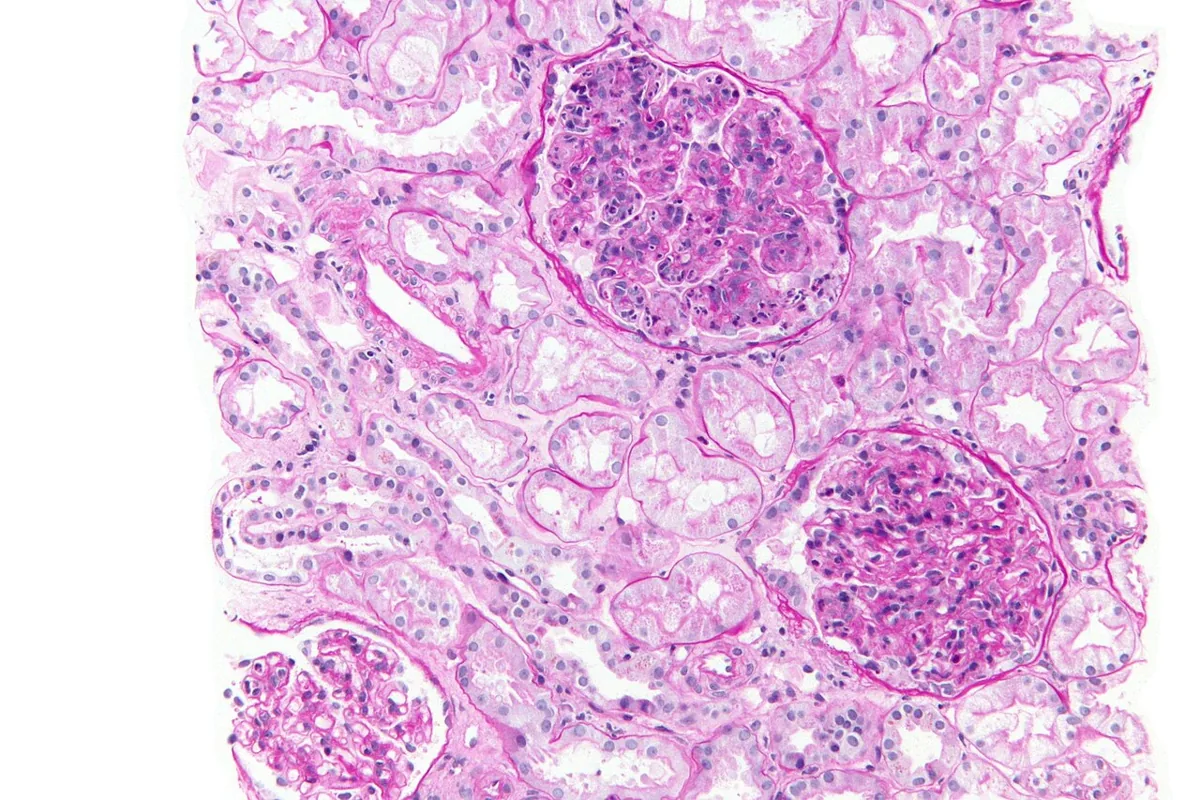 Nephritic syndrome and glomerulonephritis – Histology in post-infectious glomerulonephritis: enlarged hypercellular glomeruli with endocapillary proliferation