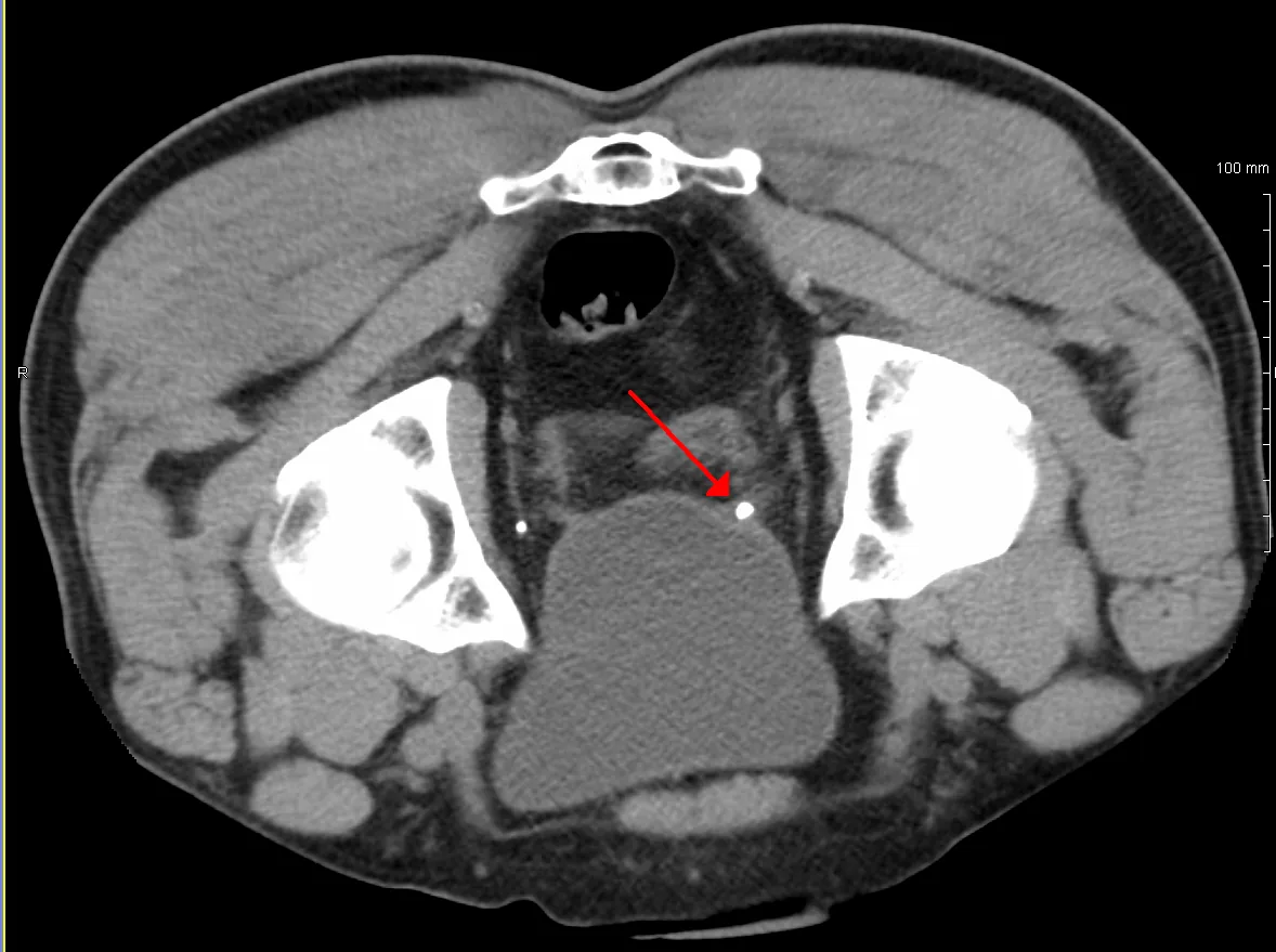 Kidney stones (nephrolithiasis) – Non-contrast CT of the pelvis: small, very dense ureteric stone at the vesicoureteric junction (arrow)