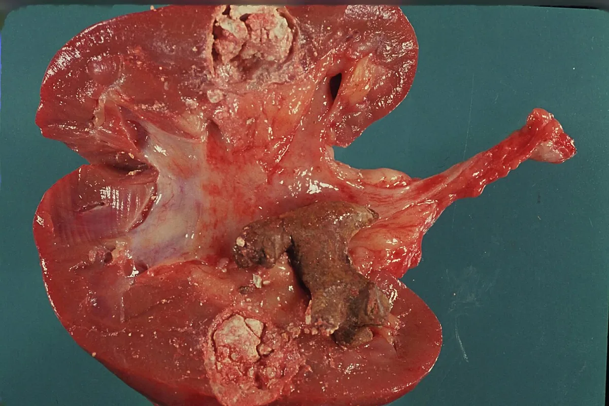 Kidney stones (nephrolithiasis) – gross specimen: Opened kidney with a calculus in the renal pelvis and whitish calcific deposits in the papillae