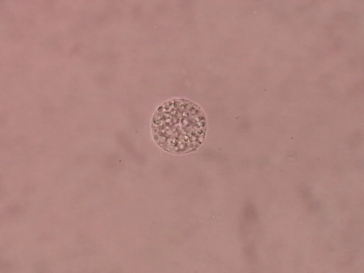 Nephrotic syndrome – blood smear/cytology: Urine sediment in heavy proteinuria: oval fat body, a tubular epithelial cell filled with lipid droplets (lipiduria)