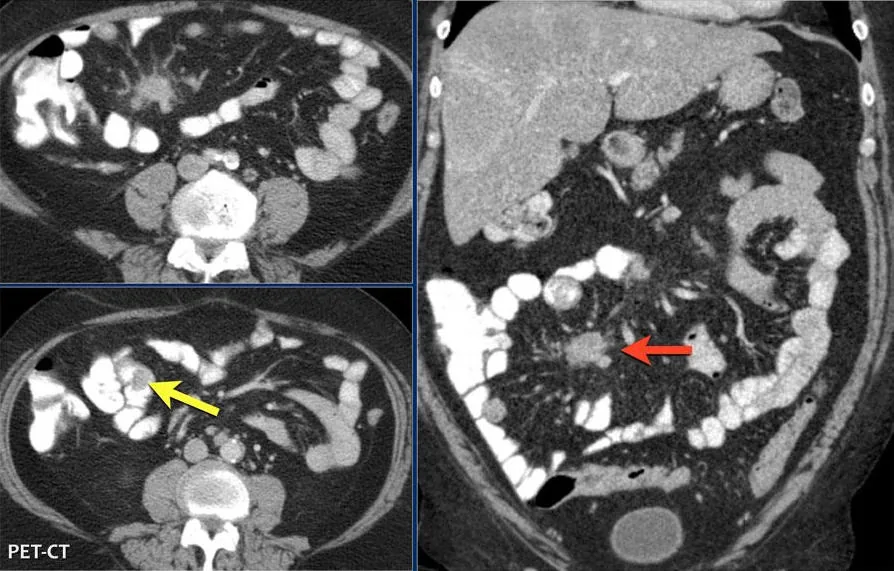 Neuroendocrine tumors and carcinoid syndrome – CT: small intraluminal small-bowel tumor (yellow arrow) and spiculated mesenteric mass with desmoplastic reaction (red arrow) in small-bowel NET
