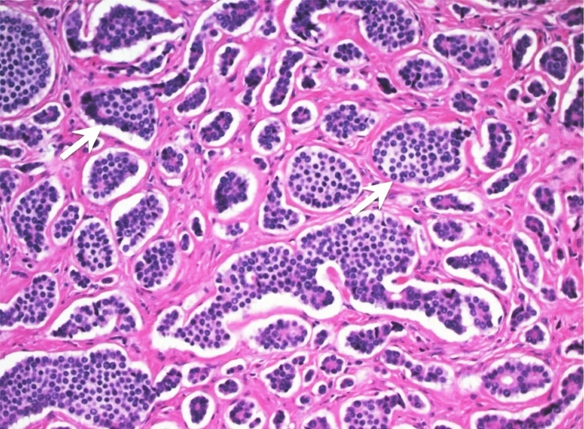 Neuroendocrine tumors and carcinoid syndrome – Histology (H&E): well-differentiated neuroendocrine tumor of the small bowel with nests of uniform cells (arrows)