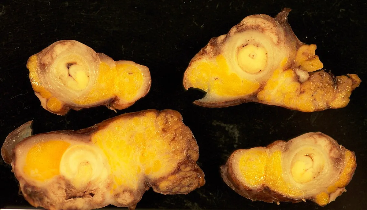 Neuroendocrine tumors and carcinoid syndrome – gross specimen: Cross-sections of the appendix: yellowish firm tumor in the wall in an appendiceal neuroendocrine tumor