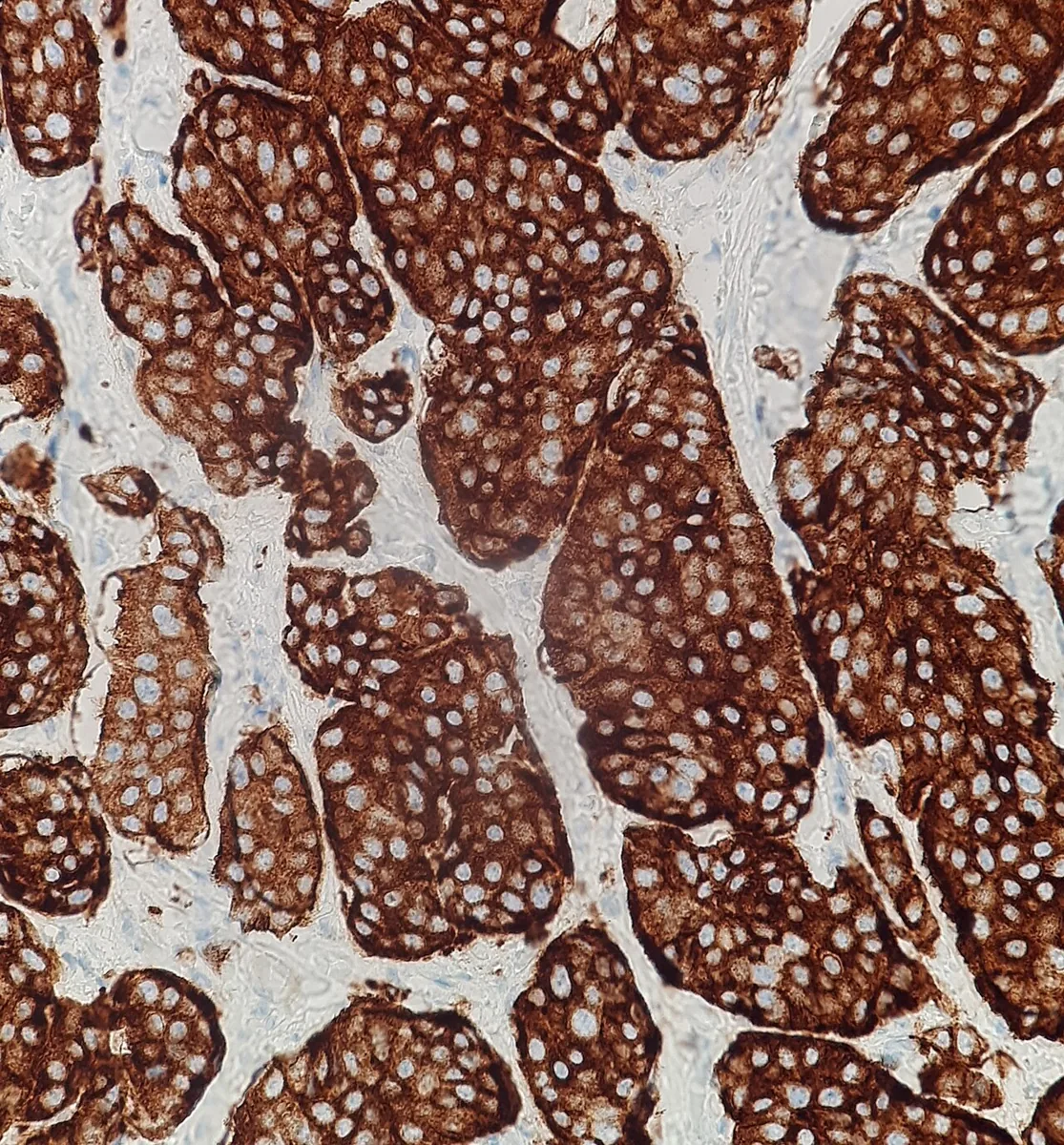 Neuroendocrine tumors and carcinoid syndrome – histology: Immunohistochemistry: strongly positive synaptophysin staining of the tumor cell nests of a neuroendocrine tumor