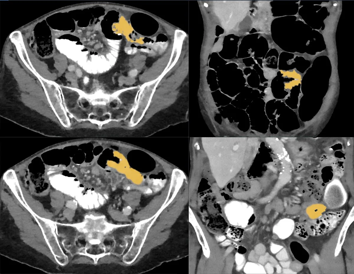 Non-Hodgkin lymphomas – CT: small-bowel non-Hodgkin lymphoma with abrupt transition to a thick-walled, dilated segment (highlighted in color)