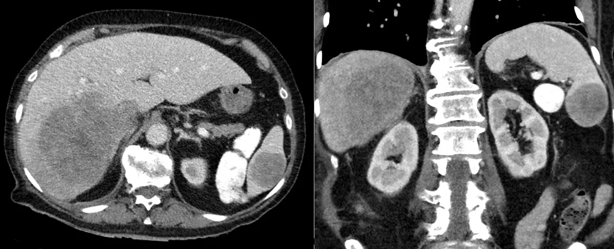 Non-Hodgkin lymphomas – CT (axial and coronal): large hypodense masses in liver and spleen due to B-cell non-Hodgkin lymphoma involvement